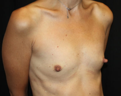 Breast Augmentation - Shaped Silicone Implants Before & After Patient #26417