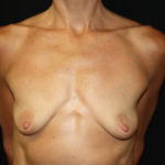 Breast Lift with Implant Before & After Patient #26754