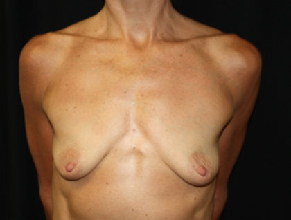 Breast Lift with Implant Before & After Patient #26754