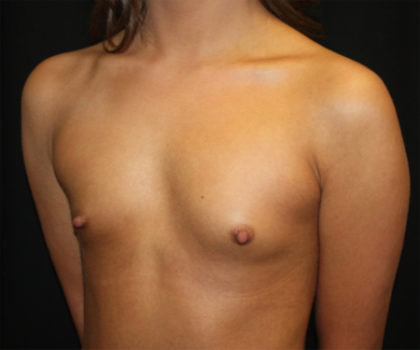 Breast Augmentation - Round Silicone Implants Before & After Patient #25715