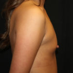 Breast Augmentation - Round Silicone Implants Before & After Patient #25715