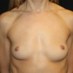 Breast Augmentation - Round Silicone Implants Before & After Patient #26339