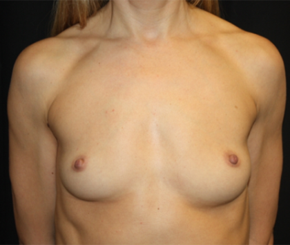 Breast Augmentation - Round Silicone Implants Before & After Patient #26339