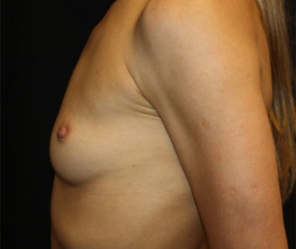 Breast Augmentation - Round Silicone Implants Before & After Patient #26339