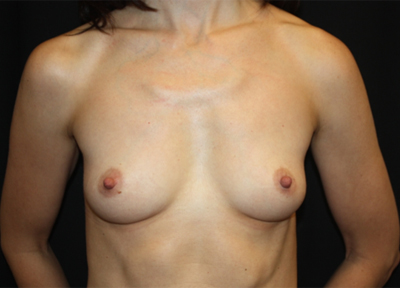 Breast Augmentation - Round Silicone Implants Before & After Patient #25693