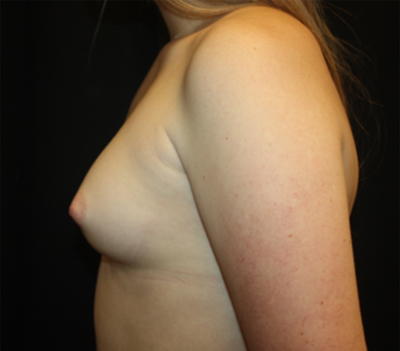 Breast Augmentation - Shaped Silicone Implants Before & After Patient #26384