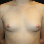 Breast Augmentation - Shaped Silicone Implants Before & After Patient #26384