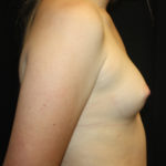 Breast Augmentation - Shaped Silicone Implants Before & After Patient #26384