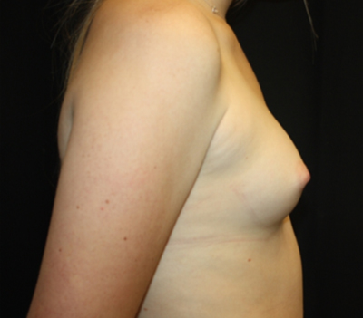 Breast Augmentation - Shaped Silicone Implants Before & After Patient #26384