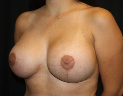 Breast Lift with Implant Before & After Patient #26783