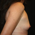 Breast Augmentation - Shaped Silicone Implants Before & After Patient #26395