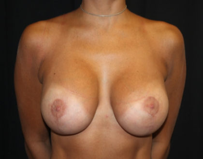 Breast Lift with Implant Before & After Patient #26776