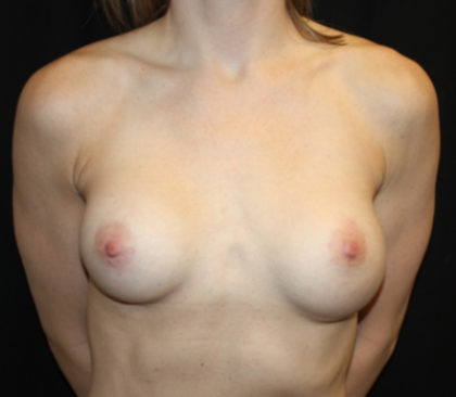 Breast Implant Exchange Before & After Patient #26572