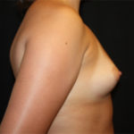 Breast Augmentation - Round Silicone Implants Before & After Patient #25495