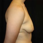 Breast Lift with Implant Before & After Patient #26695