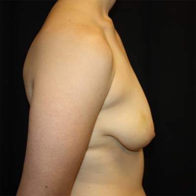 Breast Lift with Implant Before & After Patient #26695