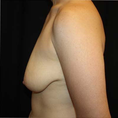 Breast Lift with Implant Before & After Patient #26695