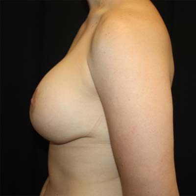 Breast Lift with Implant Before & After Patient #26695