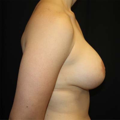 Breast Lift with Implant Before & After Patient #26695
