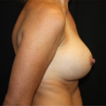 Breast Implant Exchange Before & After Patient #26583