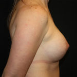 Breast Lift with Implant Before & After Patient #26794