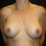 Breast Implant Exchange Before & After Patient #26594