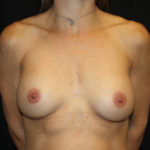 Breast Implant Exchange Before & After Patient #26594