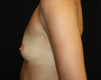 Breast Augmentation - Round Silicone Implants Before & After Patient #25513