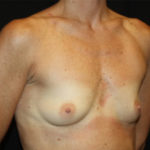 Breast Augmentation - Round Silicone Implants Before & After Patient #25513