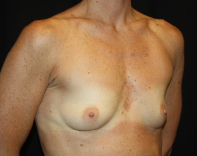 Breast Augmentation - Round Silicone Implants Before & After Patient #25513