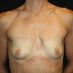 Breast Augmentation - Round Silicone Implants Before & After Patient #25513