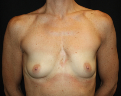 Breast Augmentation - Round Silicone Implants Before & After Patient #25513