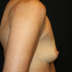 Breast Augmentation - Round Silicone Implants Before & After Patient #25513