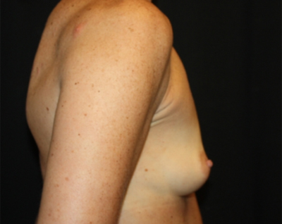 Breast Augmentation - Round Silicone Implants Before & After Patient #25513