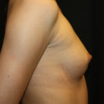 Breast Augmentation - Round Silicone Implants Before & After Patient #25542