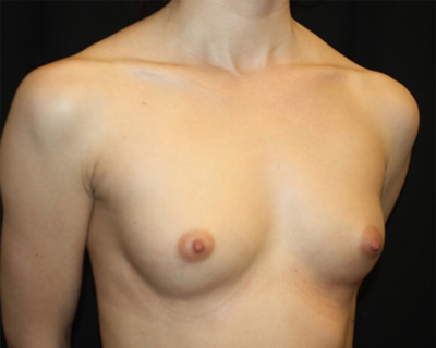 Breast Augmentation - Round Silicone Implants Before & After Patient #25542