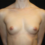 Breast Augmentation - Round Silicone Implants Before & After Patient #25542