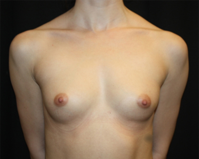 Breast Augmentation - Round Silicone Implants Before & After Patient #25542