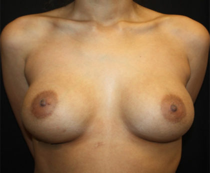 Breast Augmentation - Saline Implants Before & After Patient #26538