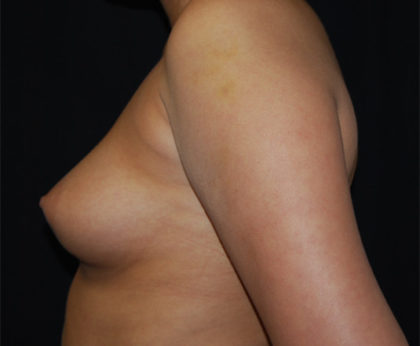 Breast Augmentation - Saline Implants Before & After Patient #26538