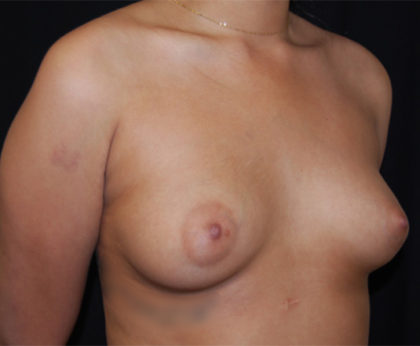 Breast Augmentation - Saline Implants Before & After Patient #26538