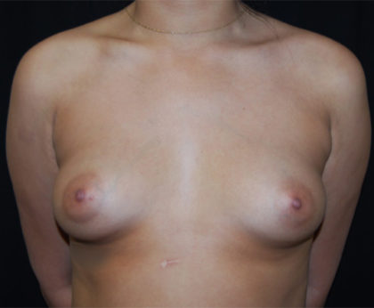 Breast Augmentation - Saline Implants Before & After Patient #26538