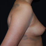 Breast Augmentation - Saline Implants Before & After Patient #26538