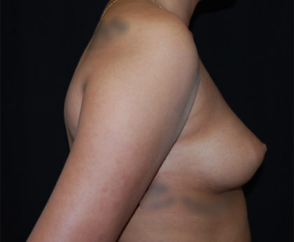 Breast Augmentation - Saline Implants Before & After Patient #26538