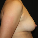 Breast Lift with Implant Before & After Patient #26805