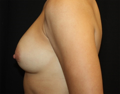 Breast Augmentation - Round Silicone Implants Before & After Patient #25660