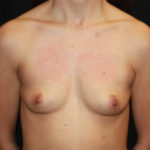 Breast Augmentation - Round Silicone Implants Before & After Patient #25553