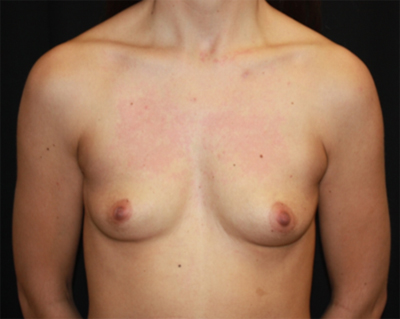 Breast Augmentation - Round Silicone Implants Before & After Patient #25553