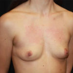 Breast Augmentation - Round Silicone Implants Before & After Patient #25553