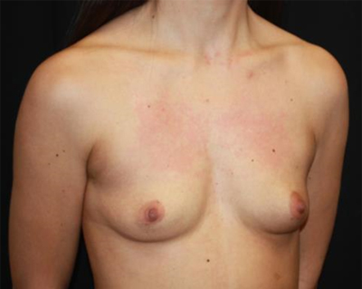 Breast Augmentation - Round Silicone Implants Before & After Patient #25553